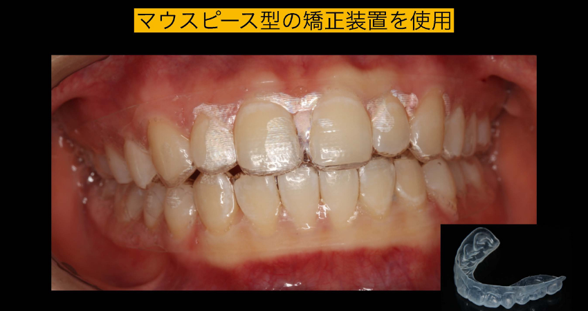 マウスピース矯正